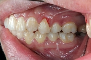 diseased teeth