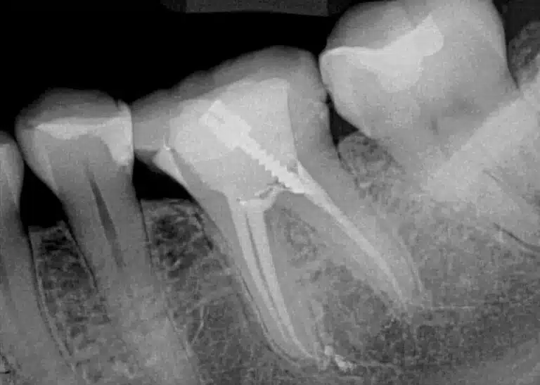 root canal x ray