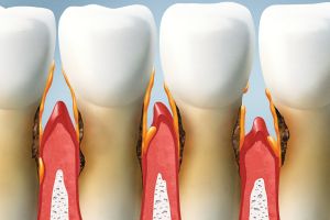 what does periodontal disease look like