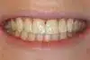 Periodontal Disease Dentist