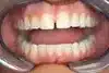 Periodontal Disease Dentist