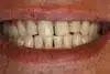 Porcelain Veneers Dentist