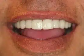 Porcelain Veneers Dentist