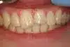 Periodontal Disease Dentist