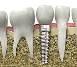 dental implants Rancho Bernardo
