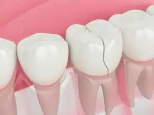 cracked tooth treatments